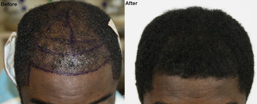 An before an after picture of a man that has had a hair transplant.